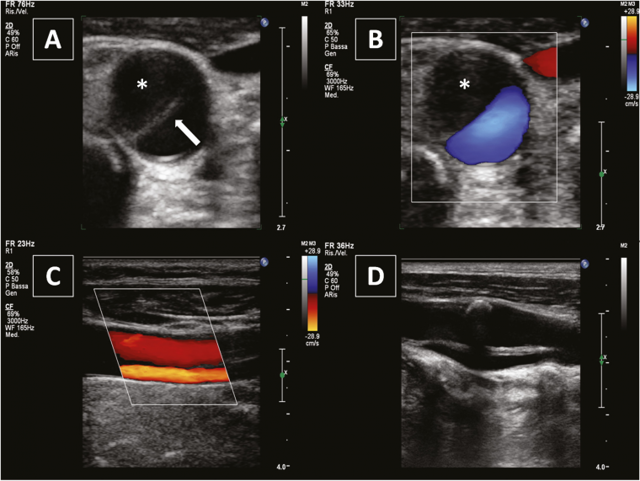 Дуплексное сканирование аорты и нижней полой вены