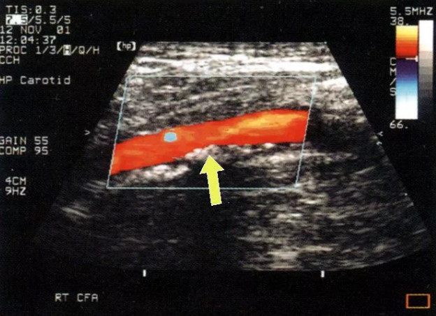 Дуплексное сканирование артерий нижних конечностей