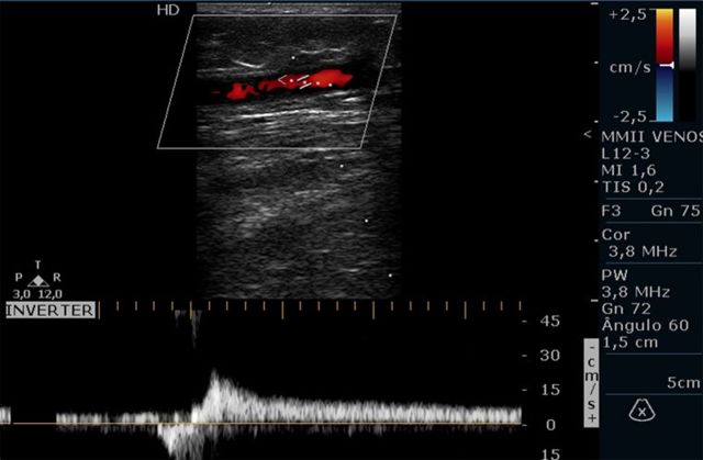 Дуплексное сканирование артерий верхних конечностей