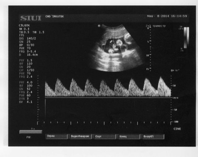 Дуплексное сканирование маточно-плацентарного кровотока