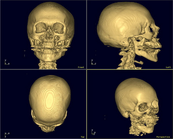 КТ костей черепа, лучевая анатомия головы