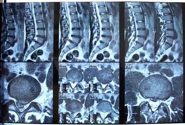 МРТ пояснично-крестцового отдела позвоночника