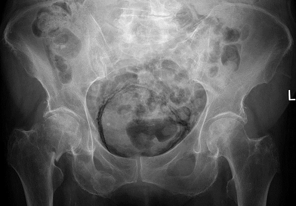 Рентген мочевого пузыря, цистография