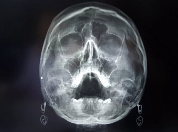 Рентген придаточных пазух носа