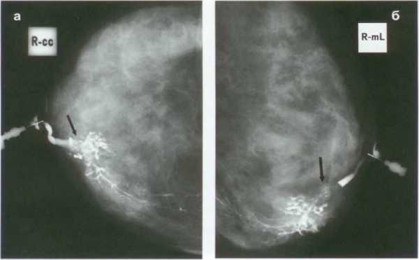 Рентген протоков молочной железы, дуктография