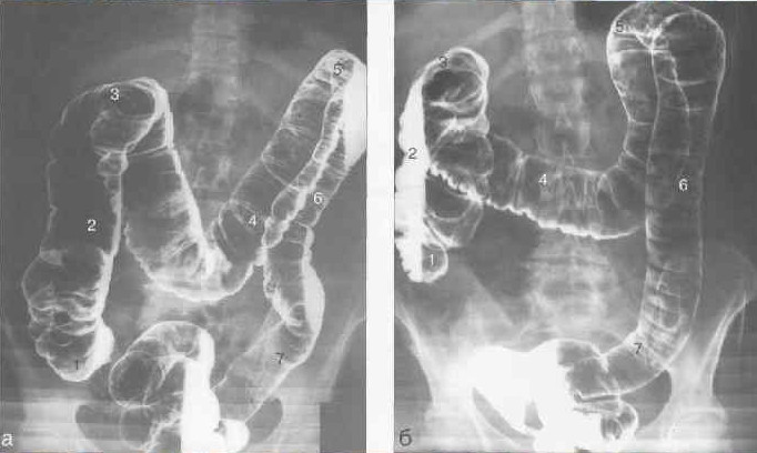Рентген толстой кишки, ирригоскопия