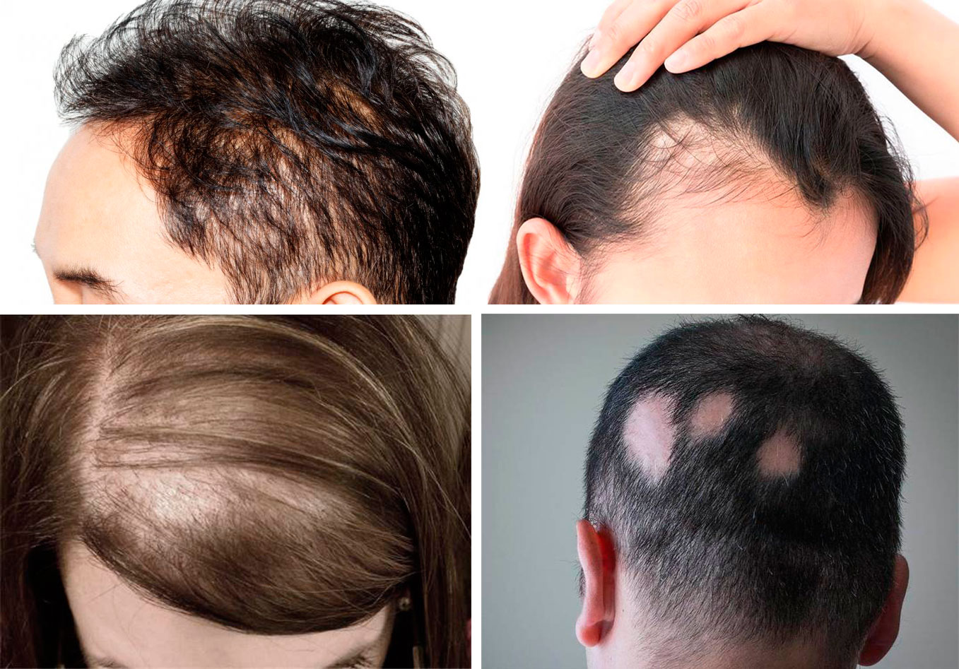 Причины выпадения волос у женщин