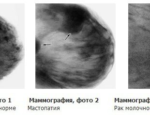 Маммография периодичность. Маммограмма онкология. Узловая мастопатия молочной железы на УЗИ. Маммография молочных желез. Узловая мастопатия на маммограмме.