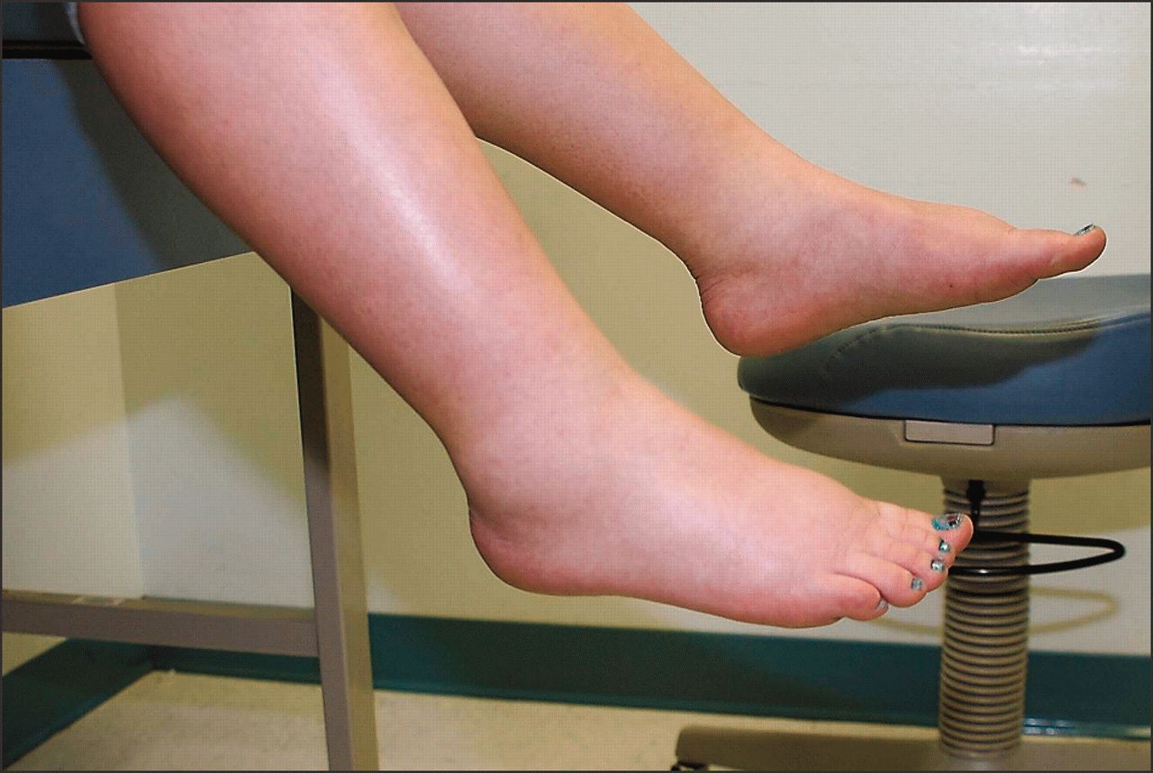 Отеки ноги: причины, симптомы и лечение