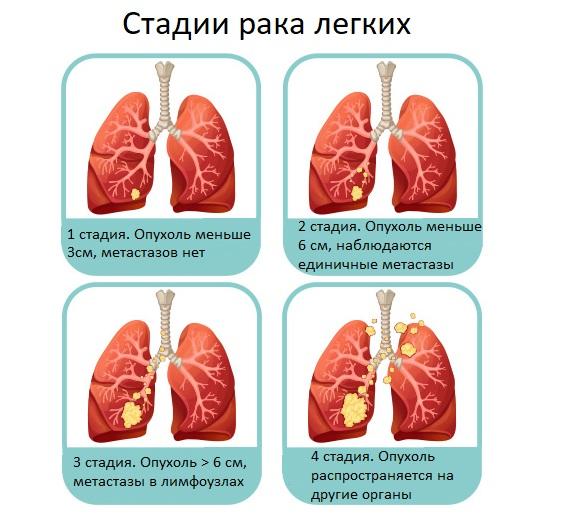 При какой форме рака легкого наблюдается картина быстротечного пневмонита