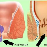 Наружный геморрой – способы быстрого и эффективного лечения