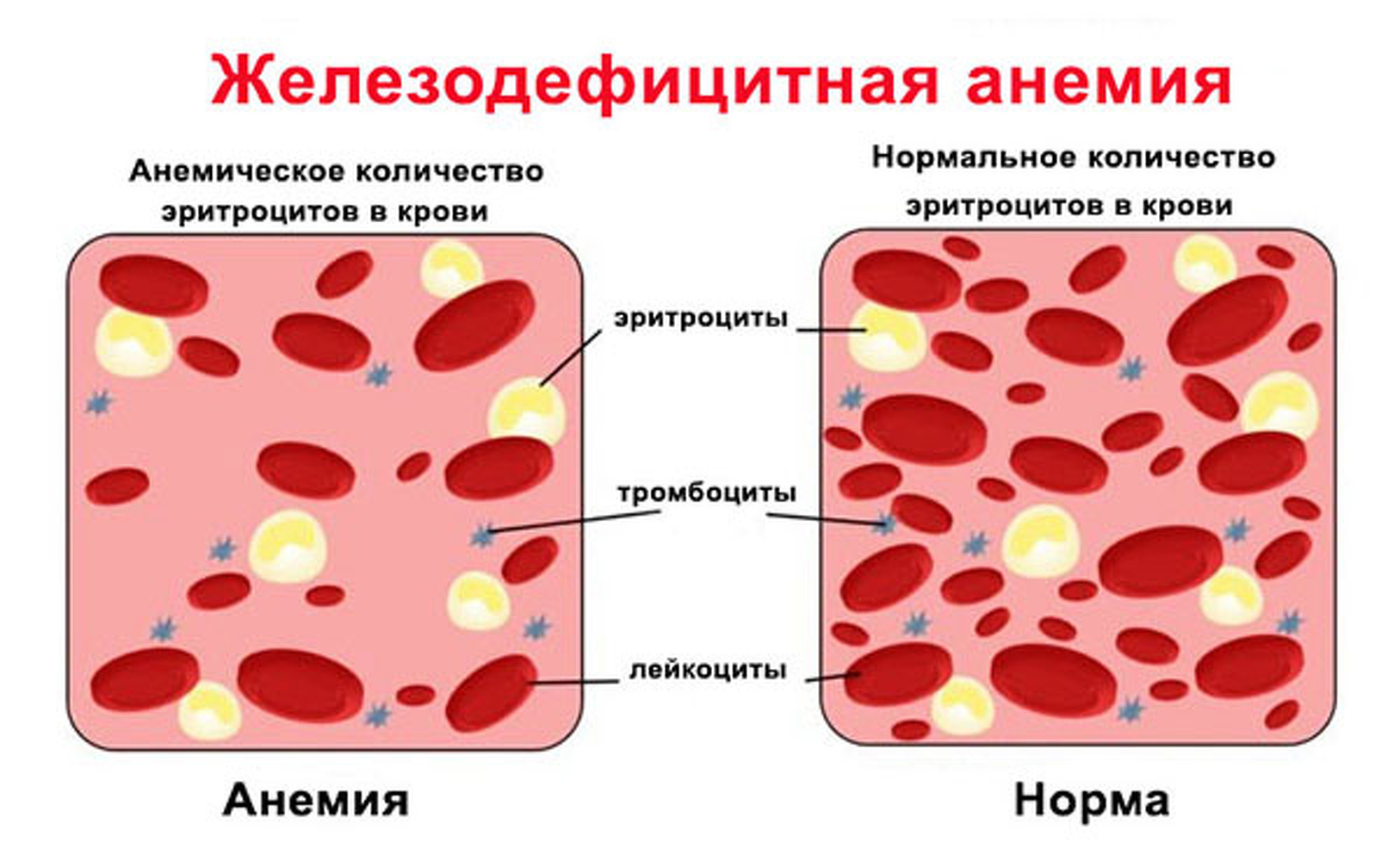 Что такое анемия и как с ней бороться? – статья на сайте Аптечество, Нижний Новгород
