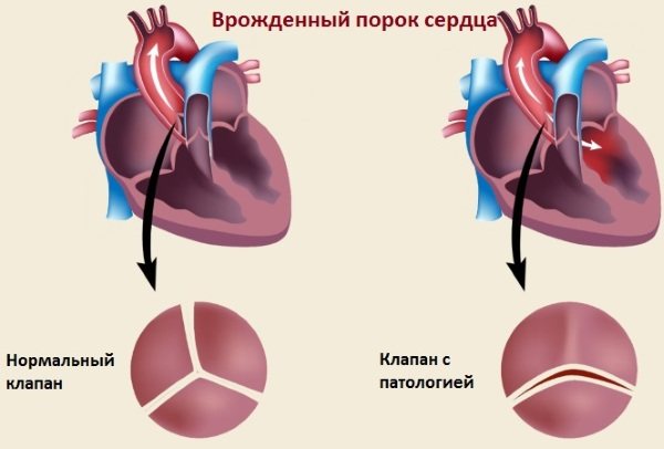Врождённый порок сердца у детей