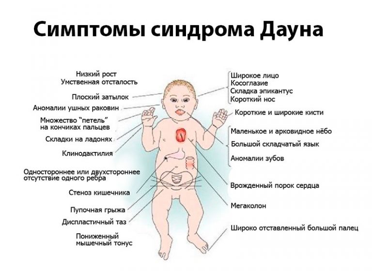 Синдром или болезнь Дауна, как выявить и лечить – запись к врачам в Москве