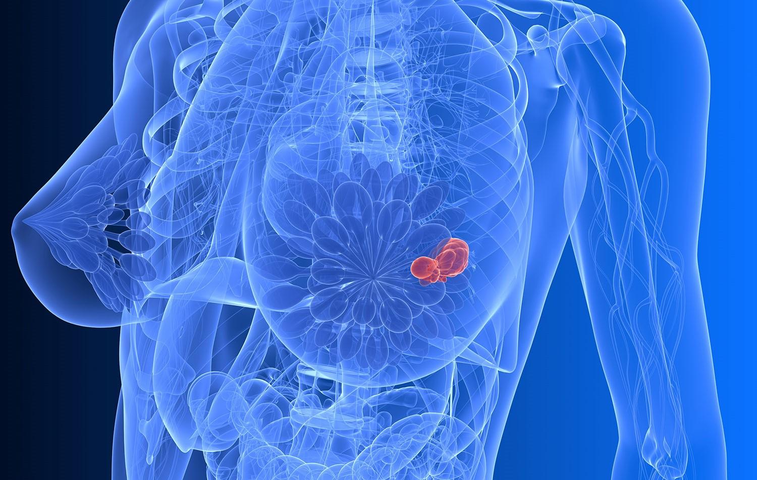 рак на груди у женщин симптомы фото 117