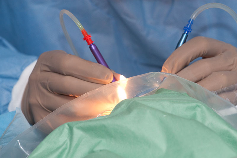 Как применяется лазер в хирургии?