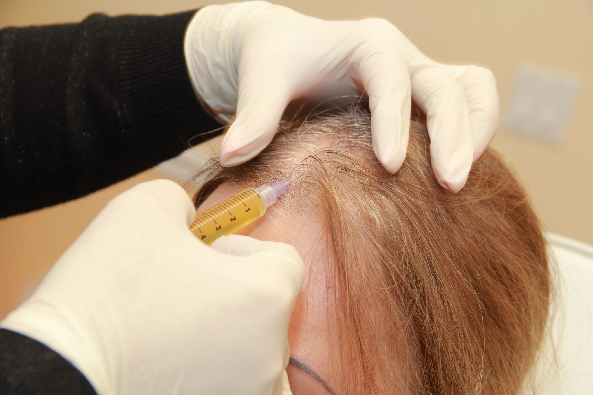 Сильное лечение волос. Плазмотерапия для волос. PRP плазмолифтинг для волос. Плазмотерапия волосистой части головы. PRP-терапия (плазмотерапия) для волос.
