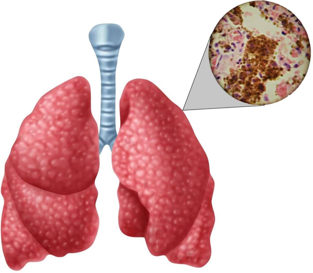 Вид туберкулеза легких 