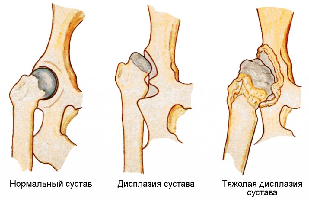 Дисплазия тазобедренного сустава презентация