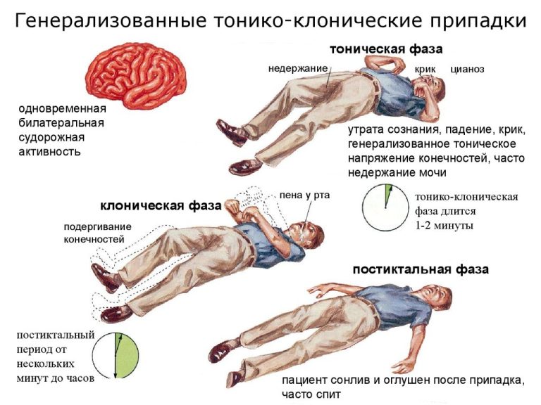 Прикус языка при эпилепсии фото