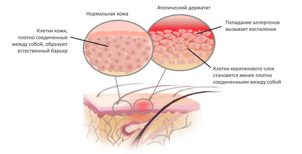 Атопический дерматит_1