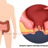 Анальные трещины: лечение, симптомы, причины, виды, профилактика и последствия заболевания