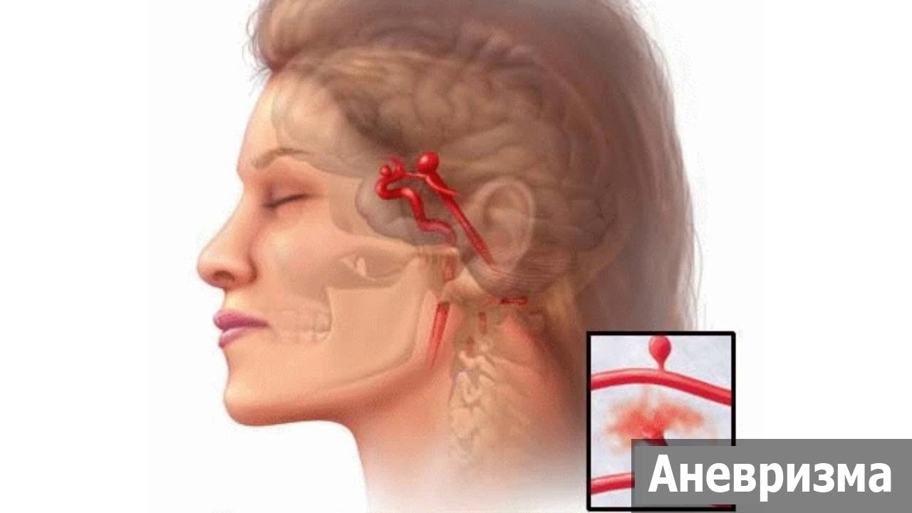 Об аневризме сонной артерии, как ее распознать и вылечить