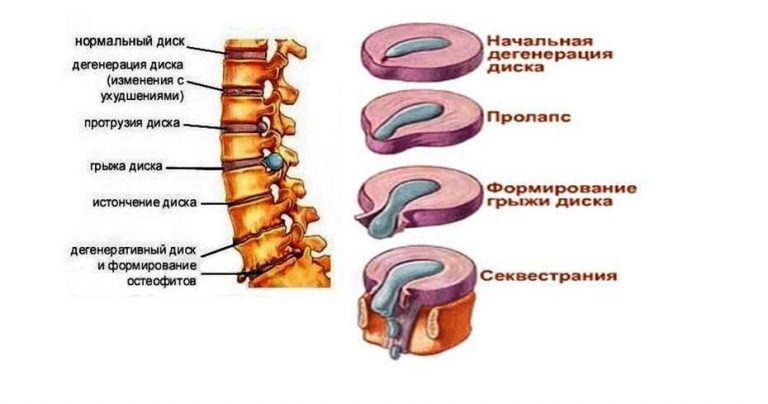 Клиническая картина остеохондроза