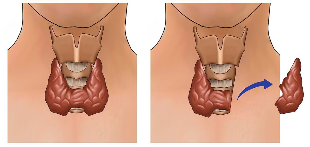 Гемитиреоидэктомия щитовидной железы