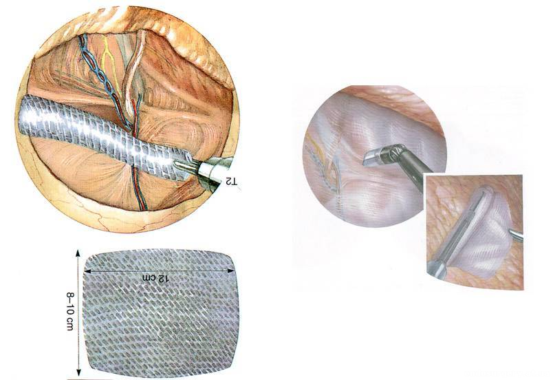 Герниопластика послеоперационной вентральной грыжи