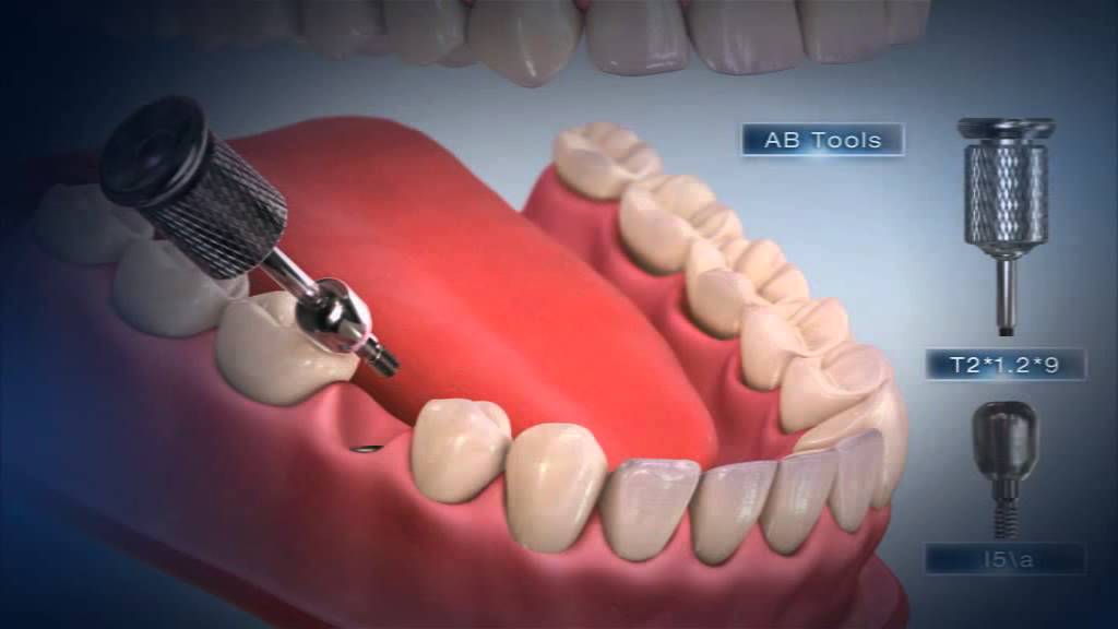 Импланты AB Dental