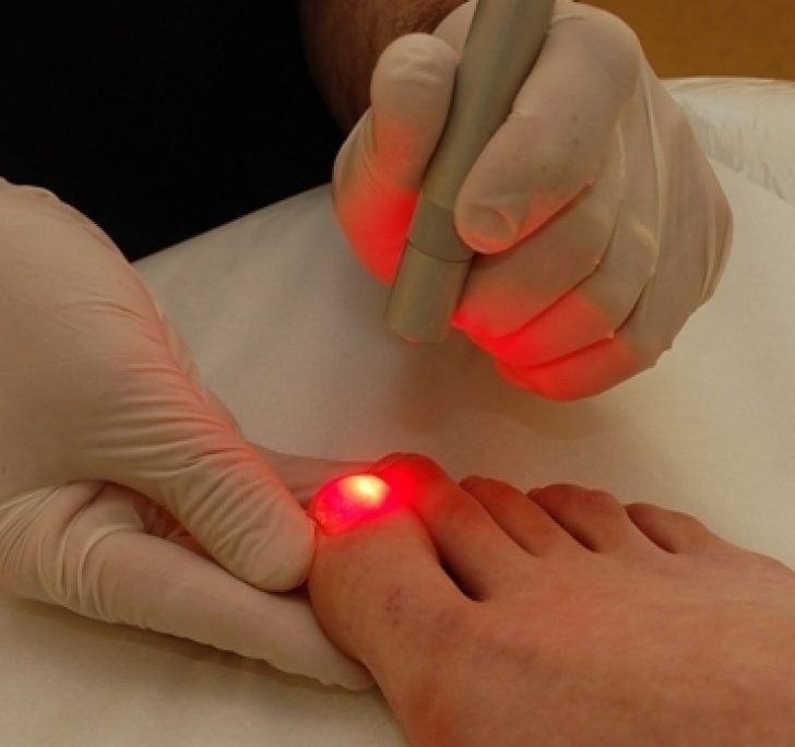 Лазерное лечение грибка ногтей
