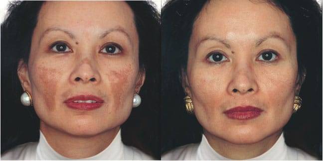 Лазерное отбеливание кожи до и после