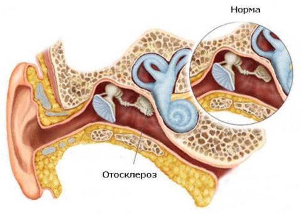 Стапедопластика уха