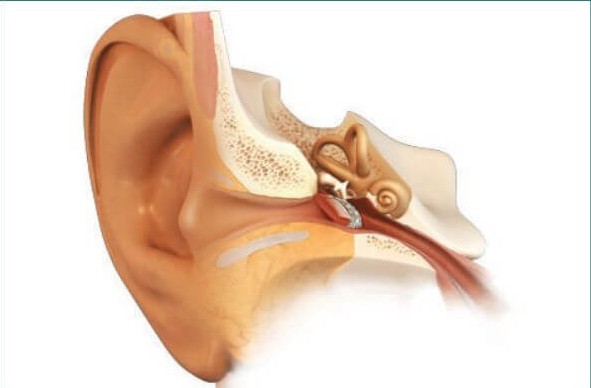 Тимпанопластика уха