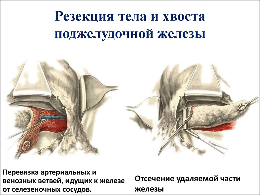 Резекция поджелудочной железы, Москва: стоимость от 130000 рублей –  МОСГОРМЕД